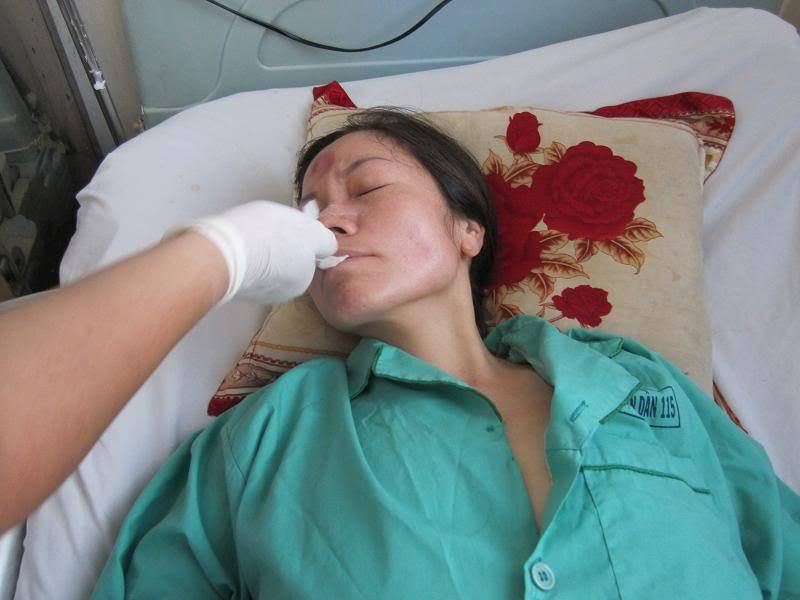 kỹ thuật đặt sonde dạ dày